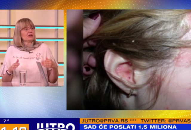 Psorijaza je mnogo više od bolesti kože, ali nije problem bez rešenja VIDEO